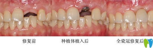 長(zhǎng)春晟諾口腔唐永旺院長(zhǎng)種植牙案例 長(zhǎng)春晟諾口腔唐永旺院長(zhǎng)種植牙案例