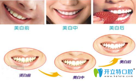 牙齒美白