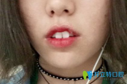 在九江奇洋口腔做了牙齒矯正，我擺脫了“兔牙妹”稱號(hào)