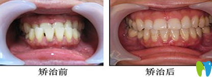 寧波拜博拜爾牙齒畸形矯正效果圖 寧波拜博拜爾牙齒畸形矯正效果圖