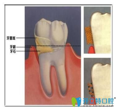 牙結(jié)石的危害你知道嗎？告別牙結(jié)石可以用這7種方法