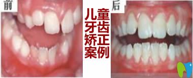 兒童牙齒正畸前后對比案例