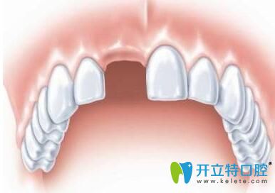 門(mén)牙缺失的趙先生在玉溪舒爾口腔做種植牙修復(fù)成功