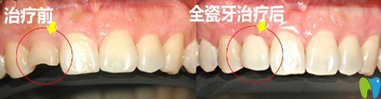 孝感口腔全瓷牙治療效果案例