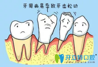 牙周病導(dǎo)致牙齒松動