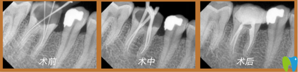牙齒蛀蟲治療過程
