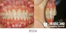在濰坊華貝口腔做了牙齒矯正，恢復(fù)后我擺脫了齙牙妹
