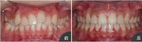 長(zhǎng)沙半島口腔張瓊為我做的牙齒矯正，一年后牙齒就變整齊