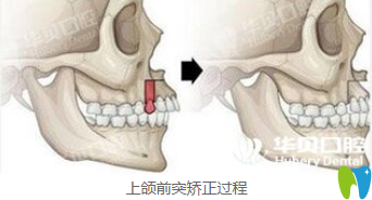 華貝口腔上頜前突矯正過(guò)程