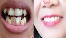 深圳拜博口腔一年半牙齒矯正結(jié)束啦，接下來(lái)開(kāi)始戴保持器
