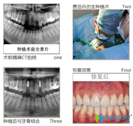 黎強(qiáng)給口牙缺失、牙槽骨萎縮幻陣采用德國(guó)費(fèi)亞丹種植技術(shù)種牙過(guò)程圖