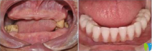 全口牙缺失怎么辦？合肥美奧口腔全口種植牙案例效果賞析