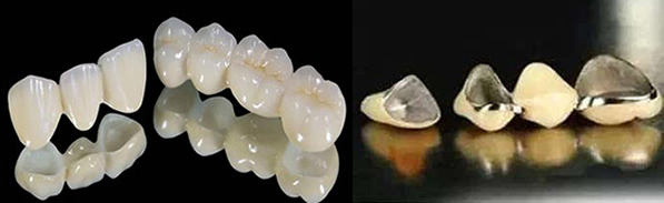 ?深圳博愛(ài)口腔解析 為什么全瓷牙價(jià)格比烤瓷牙高 區(qū)別在哪