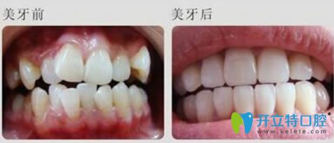 廣州華美李醫(yī)生隱適美矯正前后對比效果】 廣州華美李醫(yī)生隱適美矯正前后對比效果】