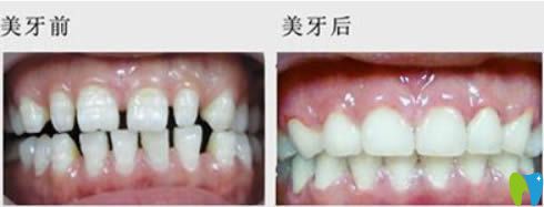 廣州華美口腔李敏華牙齒稀疏矯正前對比圖 廣州華美口腔李敏華牙齒稀疏矯正前對比圖