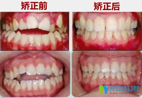 廣州華美前牙開頜正畸前后對(duì)比效果 廣州華美前牙開頜正畸前后對(duì)比效果