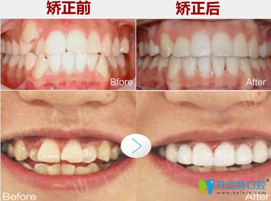 廣州華美口腔牙齒擁擠和虎牙矯正前后對(duì)比照 廣州華美口腔牙齒擁擠和虎牙矯正前后對(duì)比照