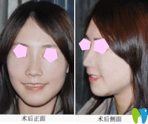 看了湛江口腔排名和收費(fèi)，選擇在南方口腔做牙齒矯正