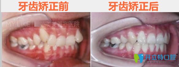 廣州美萊28歲顧客牙齒矯正前后對(duì)比照