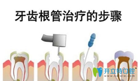 牙齒根管治療步驟和過(guò)程