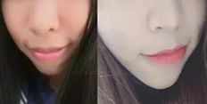 深圳牙齒矯正哪家好？看河山齒科齙牙妹正畸案例及對比圖