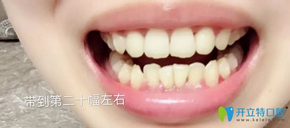 瑞德口腔矯正牙齒14個月恢復(fù)效果 瑞德口腔矯正牙齒14個月恢復(fù)效果