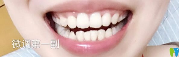 矯正牙齒后要帶牙齒保持器 矯正牙齒后要帶牙齒保持器