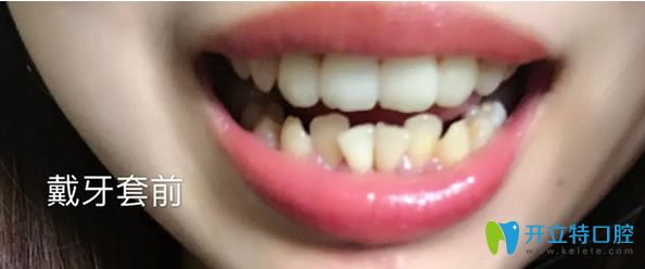 廣州瑞德口腔牙齒矯正前 廣州瑞德口腔牙齒矯正前