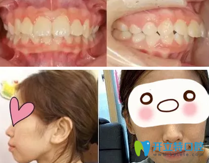 上?？泼揽谇辉趺礃?？看了我28歲牙齒矯正前后照片真是后悔