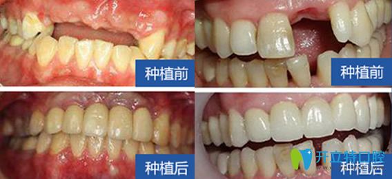 西安雁塔惟真口腔怎么樣？百萬真實案例，彰顯種植優(yōu)勢