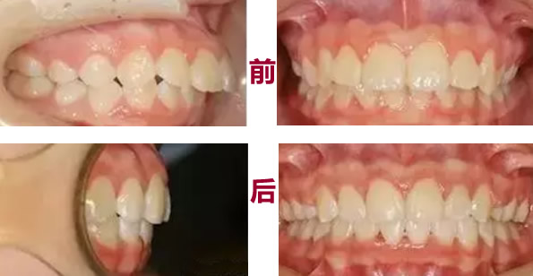 別人喊我齙牙妹 攢夠錢(qián)后在太原眾牙口腔做了金屬托槽矯正