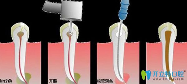 根管治療過程圖解