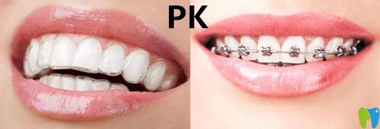 隱形矯正VS傳統(tǒng)牙套哪種效果？有什么區(qū)別呢？