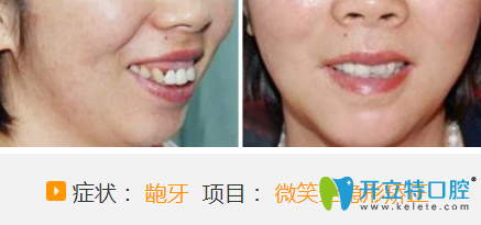 聊城哪家醫(yī)院牙齒正畸好？看聊城口腔微笑全隱形牙齒矯正案例對比圖