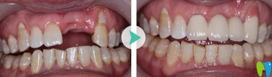 福州維樂口腔張俊偉怎么樣？看牙齒種植案例效果