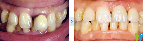 張俊偉烤瓷牙失敗修復案例