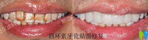 北京斯邁爾齒科楊雷牙齒美學修復效果圖