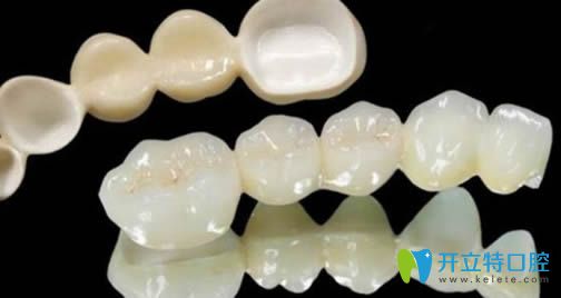 蘇文泰解析活動(dòng)假牙的種類及價(jià)格