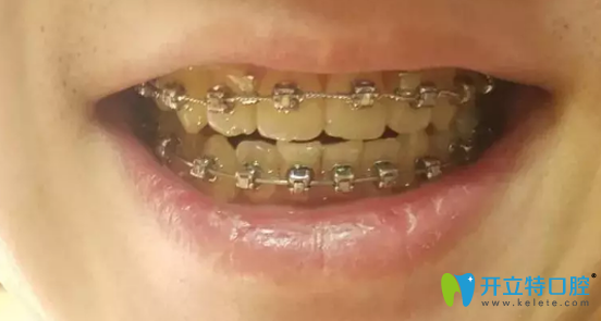 華美口腔摘牙套前較后一次復(fù)診