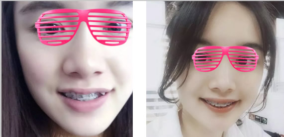 虎牙矯正 20歲妹子在上海維樂(lè)口腔帶牙套1~12月變化圖