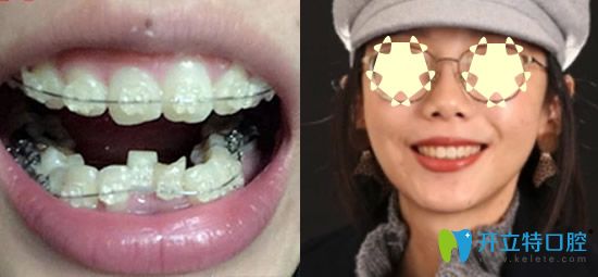  重慶整牙哪家？看重慶樂樂欣口腔牙齒矯正真人案例