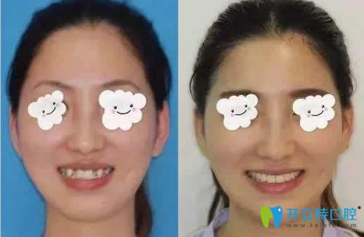 長沙雅美口腔程星醫(yī)生隱形牙齒矯正案例效果對比圖