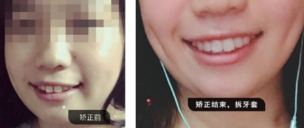看到廣州德仁口腔正畸效果 朋友問(wèn)我做隱形矯正牙齒多少錢(qián)