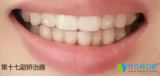 在<!--<i data=20240703-sp></i>-->華美佩戴第17副隱適美牙套的效果