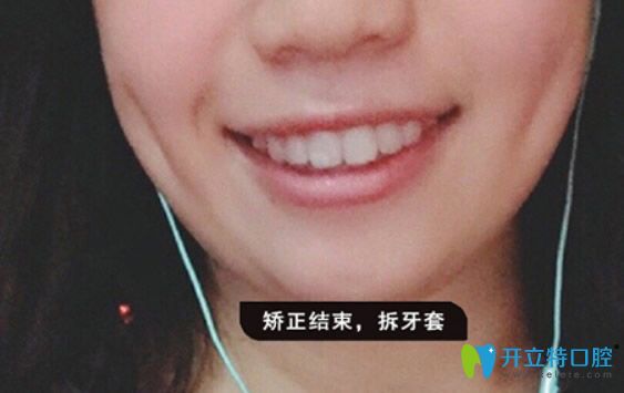廣州德仁口腔隱形正畸14個(gè)月效果