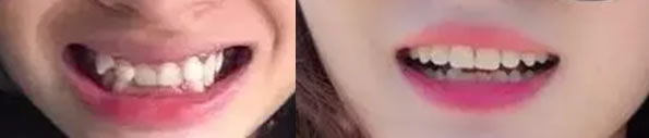 ?虎牙前突 大連沙醫(yī)生口腔金屬托槽矯正讓我實(shí)現(xiàn)整牙夢想