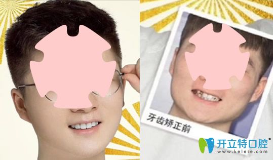 去珠海愛思特口腔做牙齒不齊、個(gè)別反頜矯正案例對比圖