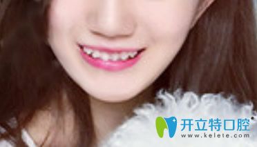 泉州牙博士口腔虎牙矯正第4個月照片