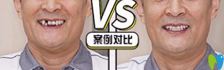 泉州牙博士好不好？牙博士單顆牙缺失即刻種植案例來證明