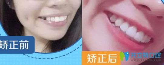 泉州牙博士口腔好嗎?透露牙博士口腔種植牙/正畸案例及價(jià)格